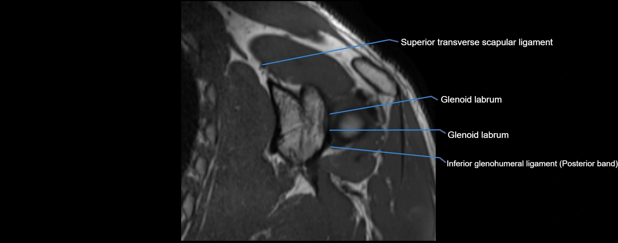 shoulder ligments coronal  cross sectional anatomy 3T MRI AI enhanced radiology image -img-00001-00034.webp